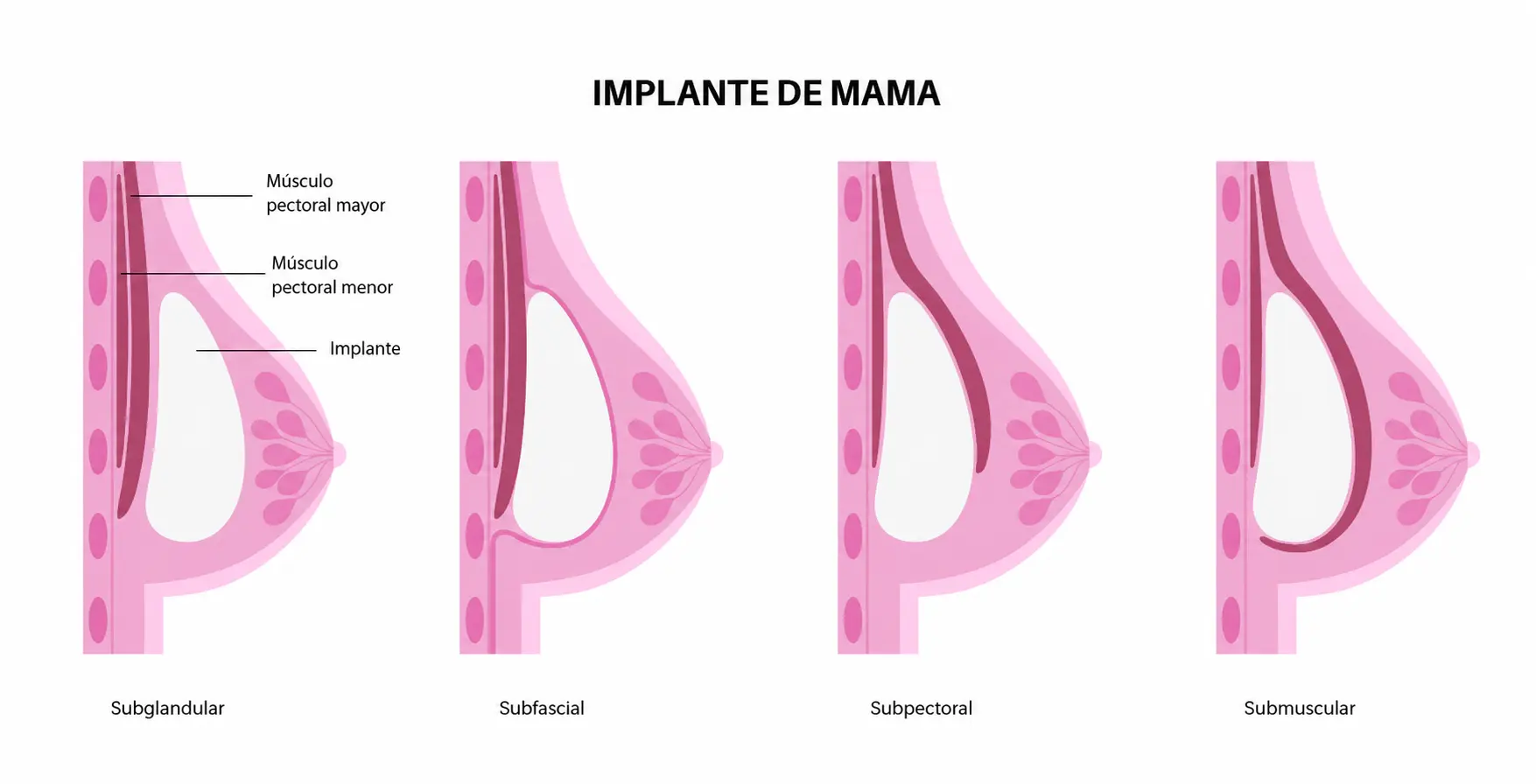 Zonas donde se coloca el implante
